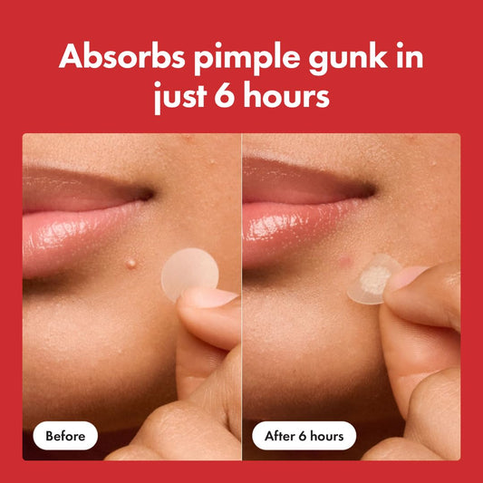 Advanced Korean Acne Patches(36patches)